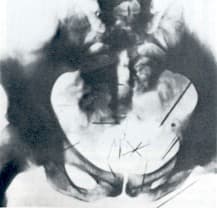 Radiografia da pélvis de Albert Fish mostrando agulhas cravadas